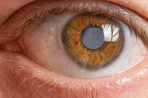 cataract