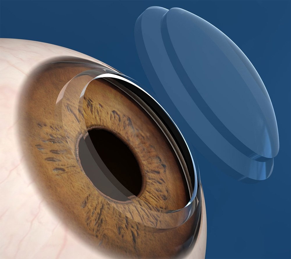 cornea