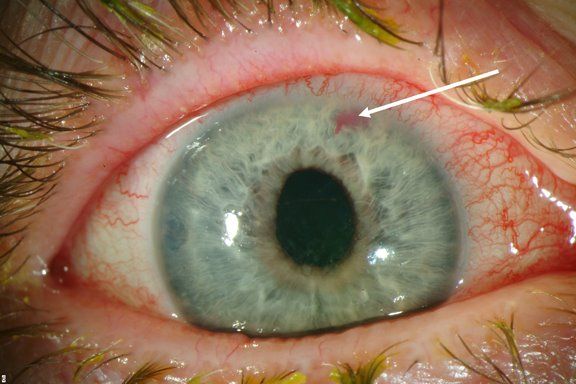 glaucoma